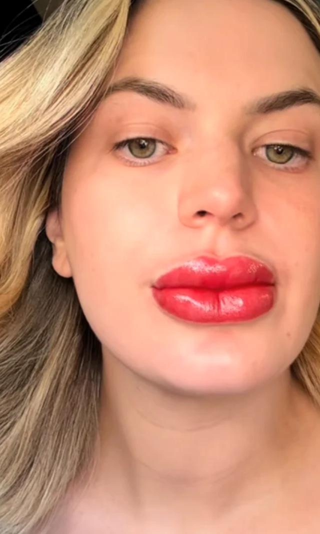 Šok na TikToku: šla je na “nežen” tretma ustnic – ko je pokazala rezultat, so ljudje obstali brez besed